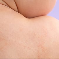 Atopische Babyhaut