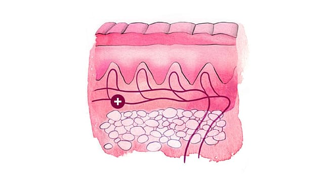 Illustration eines Hautquerschnitts: Lederhaut
