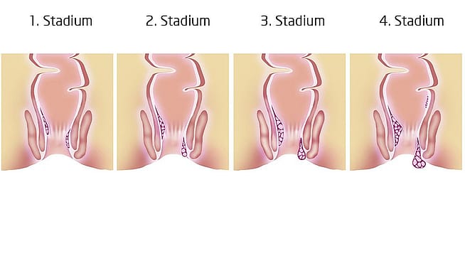 Illustration der 4 Stadien von Haemorrhoiden