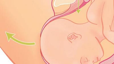 schéma accouchement