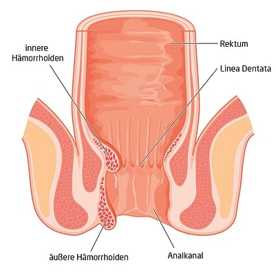 Medizinischer Querschnitt durch den Anus