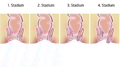 Illustration der 4 Stadien von Haemorrhoiden