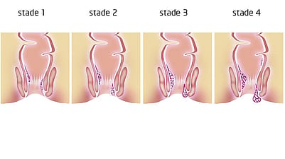 Illustration des 4 stades des hémorroïdes