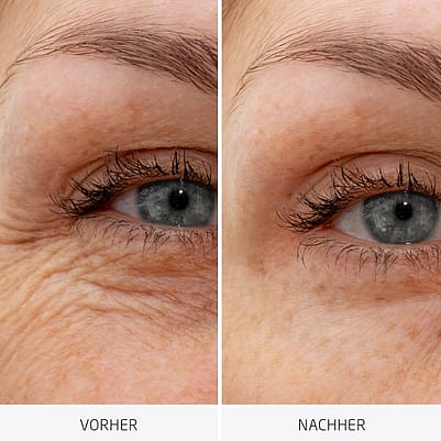 Comparación de arrugas del contorno de ojos