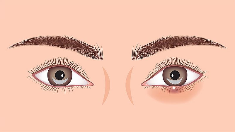 Illustration eines gesunden Auges und eines Auges mit Gerstenkorn