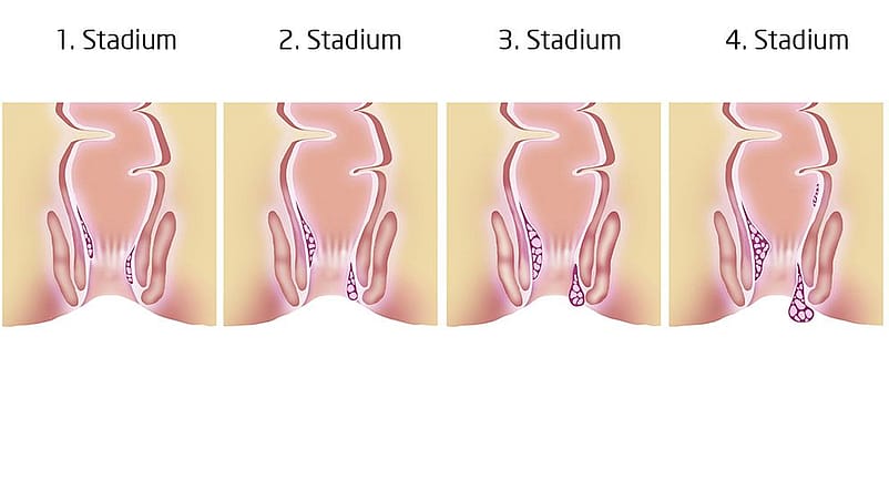 Illustration der 4 Stadien von Haemorrhoiden