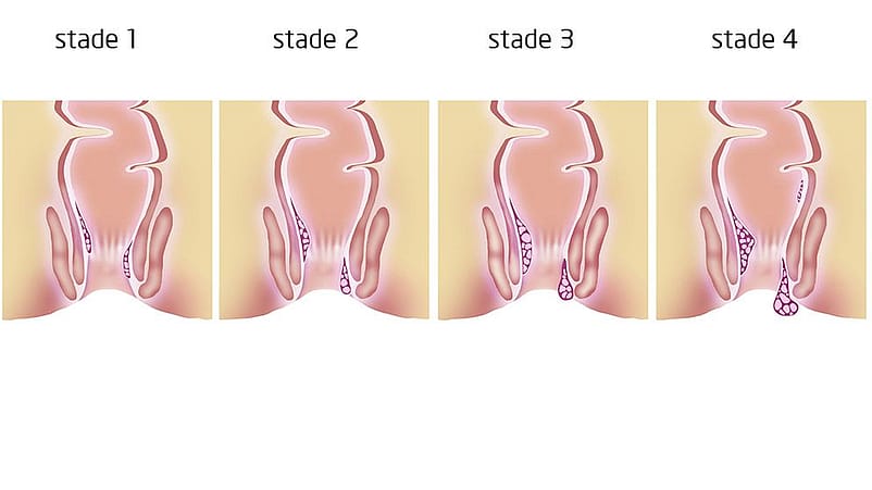 Illustration des 4 stades des hémorroïdes