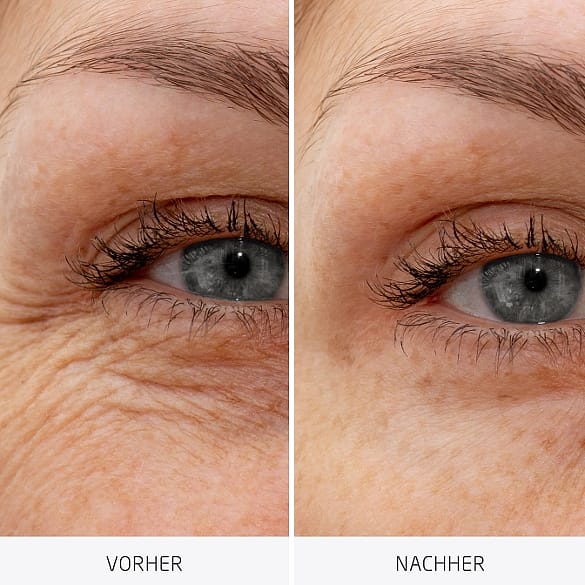 Comparación de arrugas del contorno de ojos