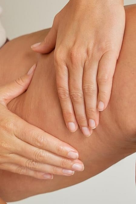 Cellulite