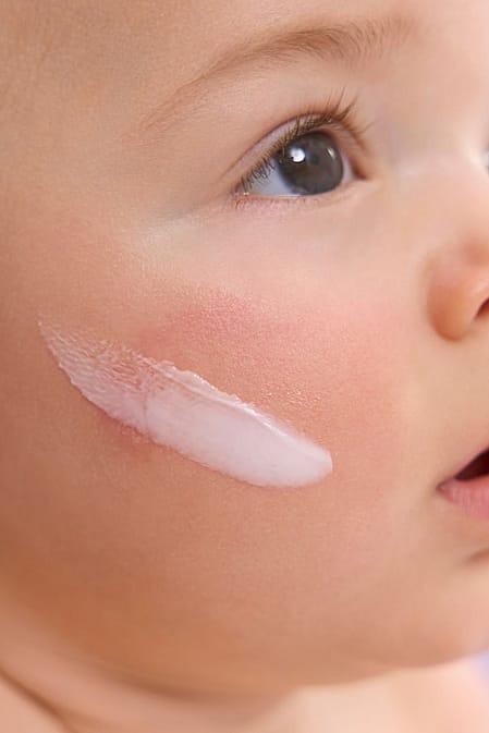 bebé con piel atópica y crema en la cara