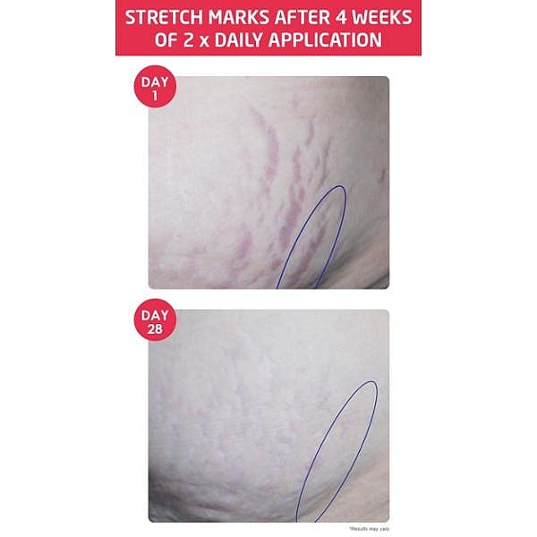 Stretch mark before and after images after 4 weeks of daily applications.
